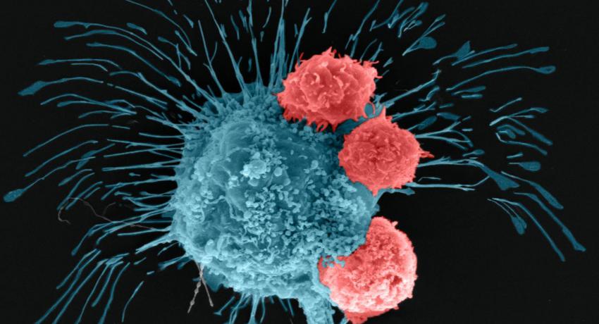 Bioprinting Breast Cancer Tumor
